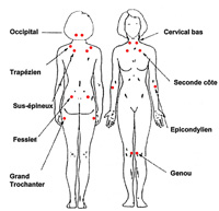 La Fibromyalgie