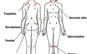La Fibromyalgie