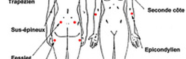 La Fibromyalgie
