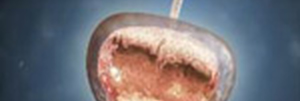 Actualité fibro - spasmo.