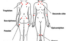 La Fibromyalgie